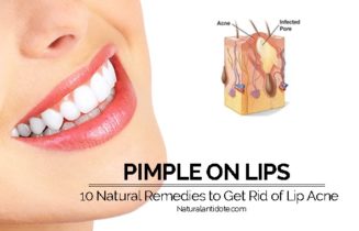 How To Get Rid Of A Painful Lip Pimple